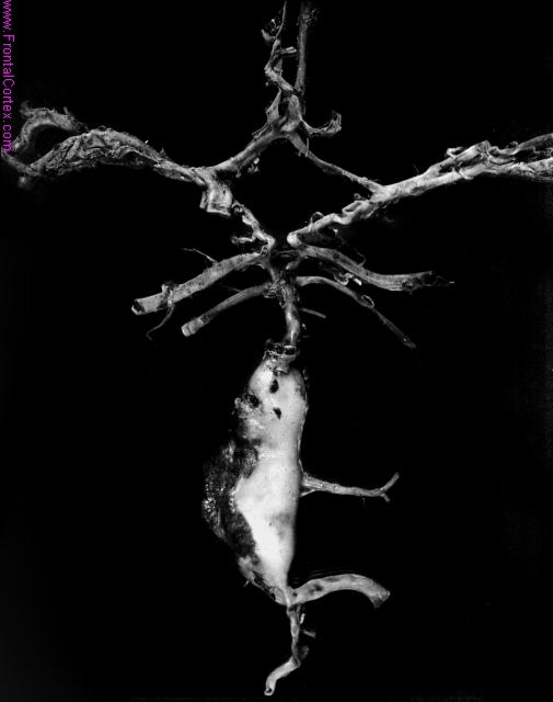 Fibromuscular dysplasia involving vertebral artery